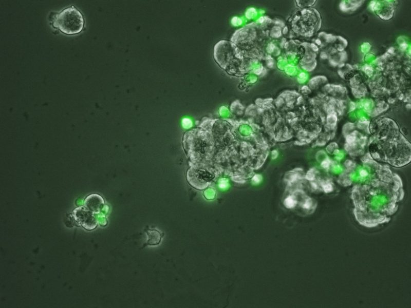 Cancer spheroids attacked by macrophages.
